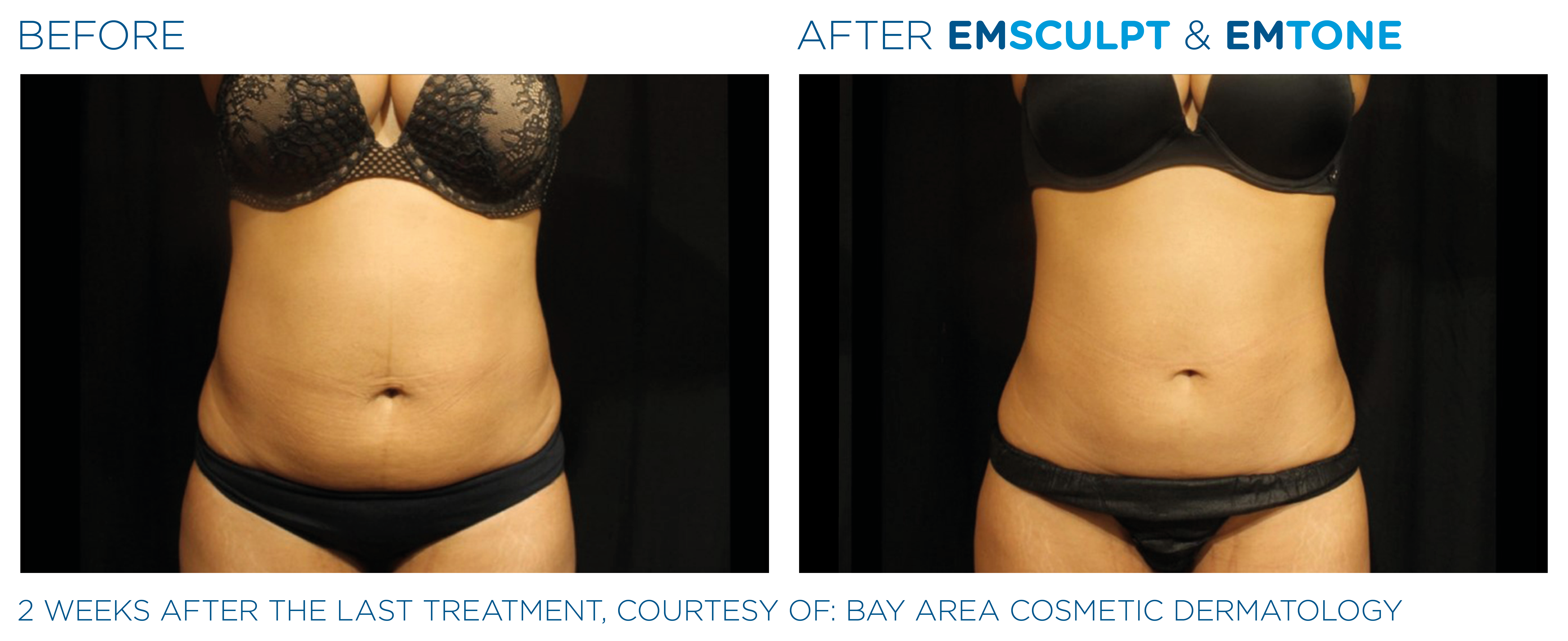 Emsculpt Emtone PIC Ba card female abdomen