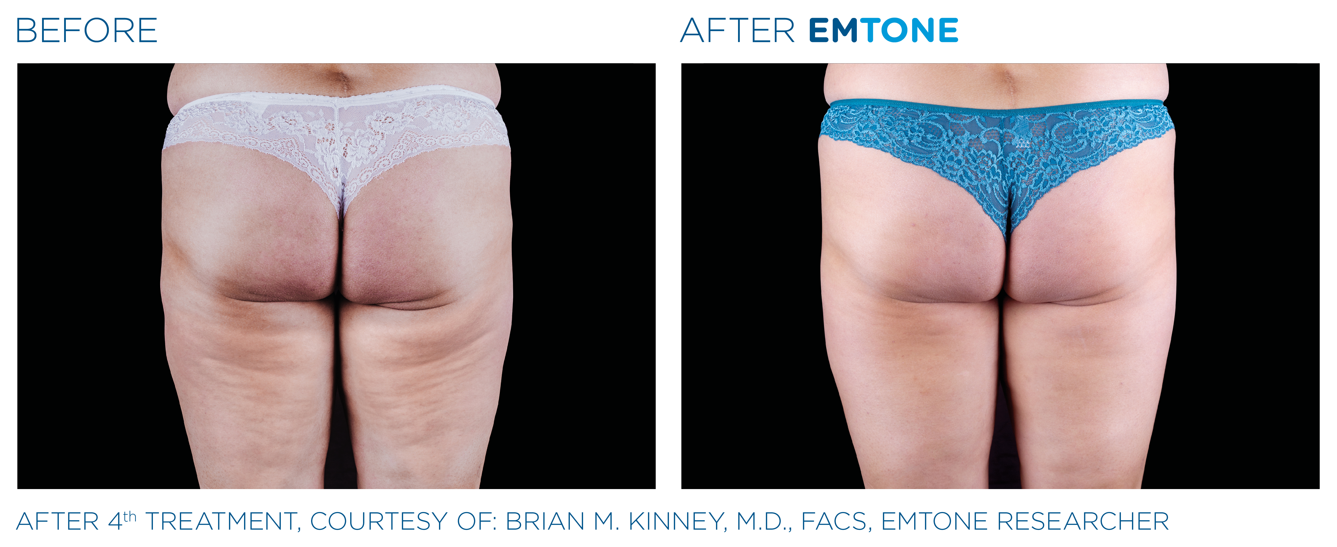 cellulite reduction before and after