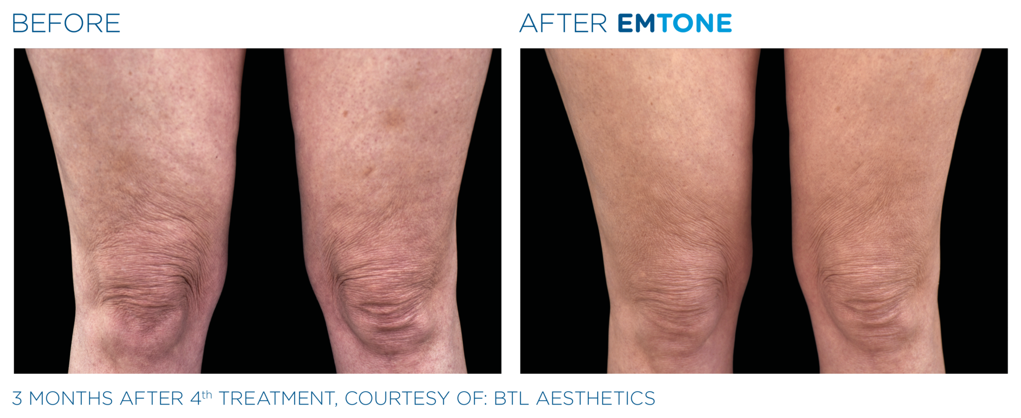 Best Cellulite and Fat Removal Treatment | BTL Emtone London