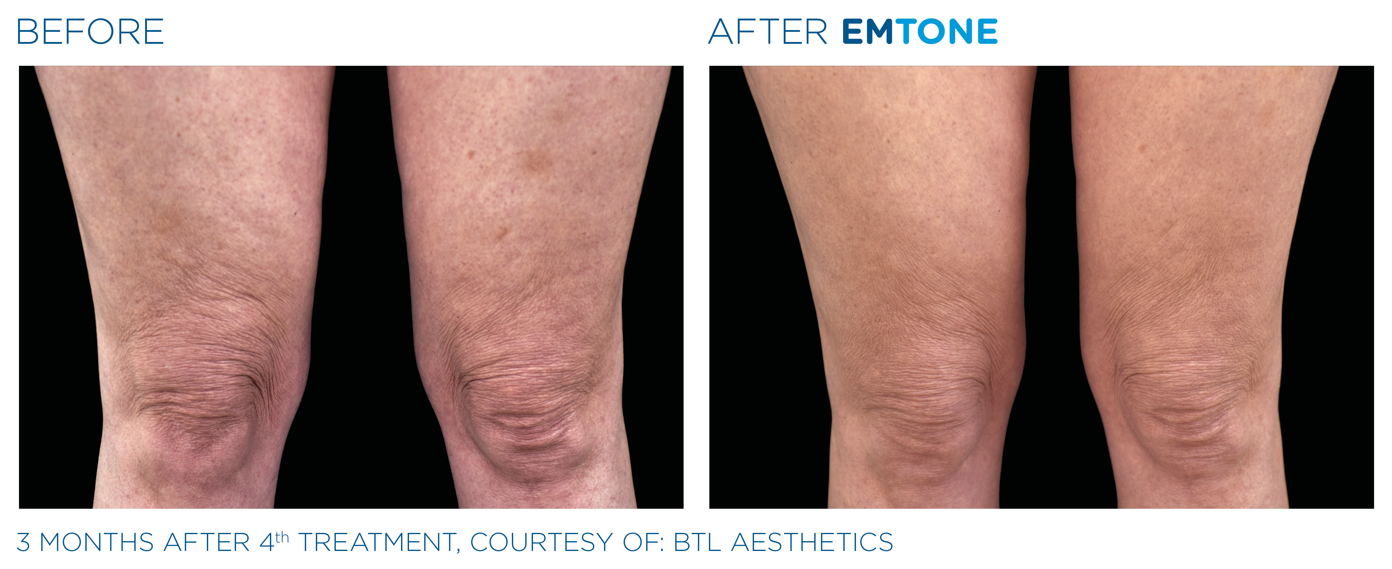 The Bottom line - Cellulite reduction - Shape and Tone Aesthetics