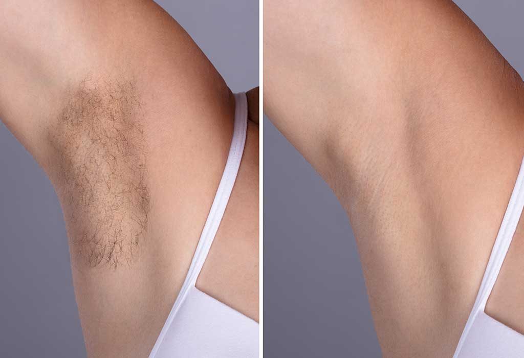 laser hair removal before and after