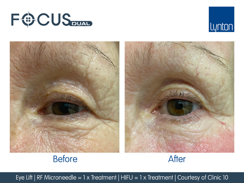 Eye Lift - Before and After 1 Focus Dual HIFU and 1 RF Microneedling Treatments
