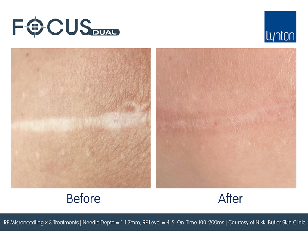 Focus Dual Before and After 3 RF Microneedling Treatments Nikki Butler Skin Clinic