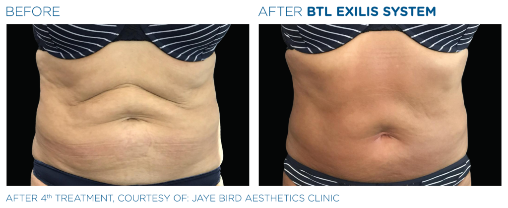 Radio Frequency Tummy Tightening Before and After London