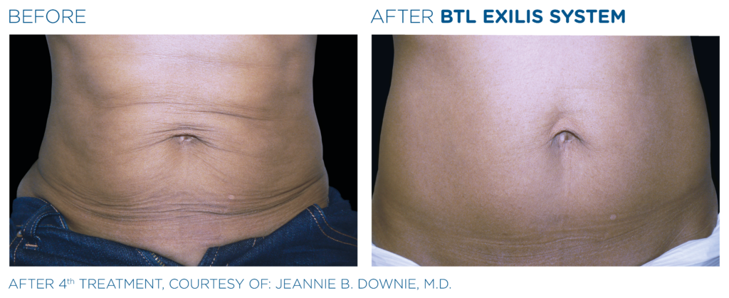 BTL Exilis system PIC Ba card female abdomen