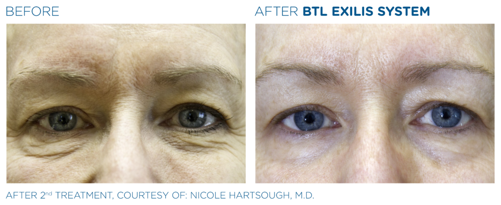 BTL Exilis system PIC Ba card female eyes