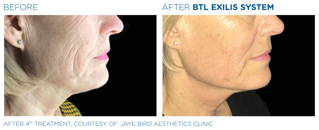 BTL Exilis system PIC Ba card female face neck